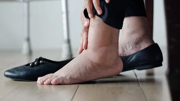 آیا تورم پا به خستگی محدود می‌شود یا زنگ خطری برای قلب است؟