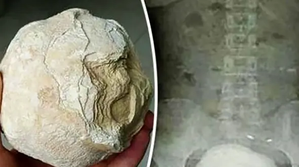 ماجرای وحشتناک بالا آمدن شکم دختر بندرعباسی+ عکس