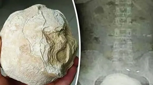 ماجرای وحشتناک بالا آمدن شکم دختر بندرعباسی+ عکس