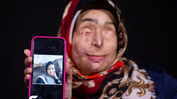 خودکشی شوهر بعد از اسیدپاشی به صورت نرگس الحلفی / نرگس کمک می خواهد + فیلم گفتگوی اختصاصی