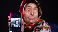 خودکشی شوهر بعد از اسیدپاشی به صورت نرگس الحلفی / نرگس کمک می خواهد + فیلم گفتگوی اختصاصی