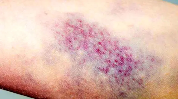 6 دلیل کبودی بدن بدون ضربه 