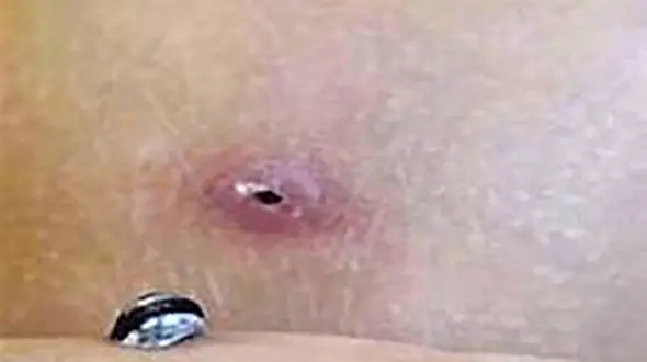 حلزون دریایی زیر پوست کودک بازیگوش زندگی می کرد! + عکس