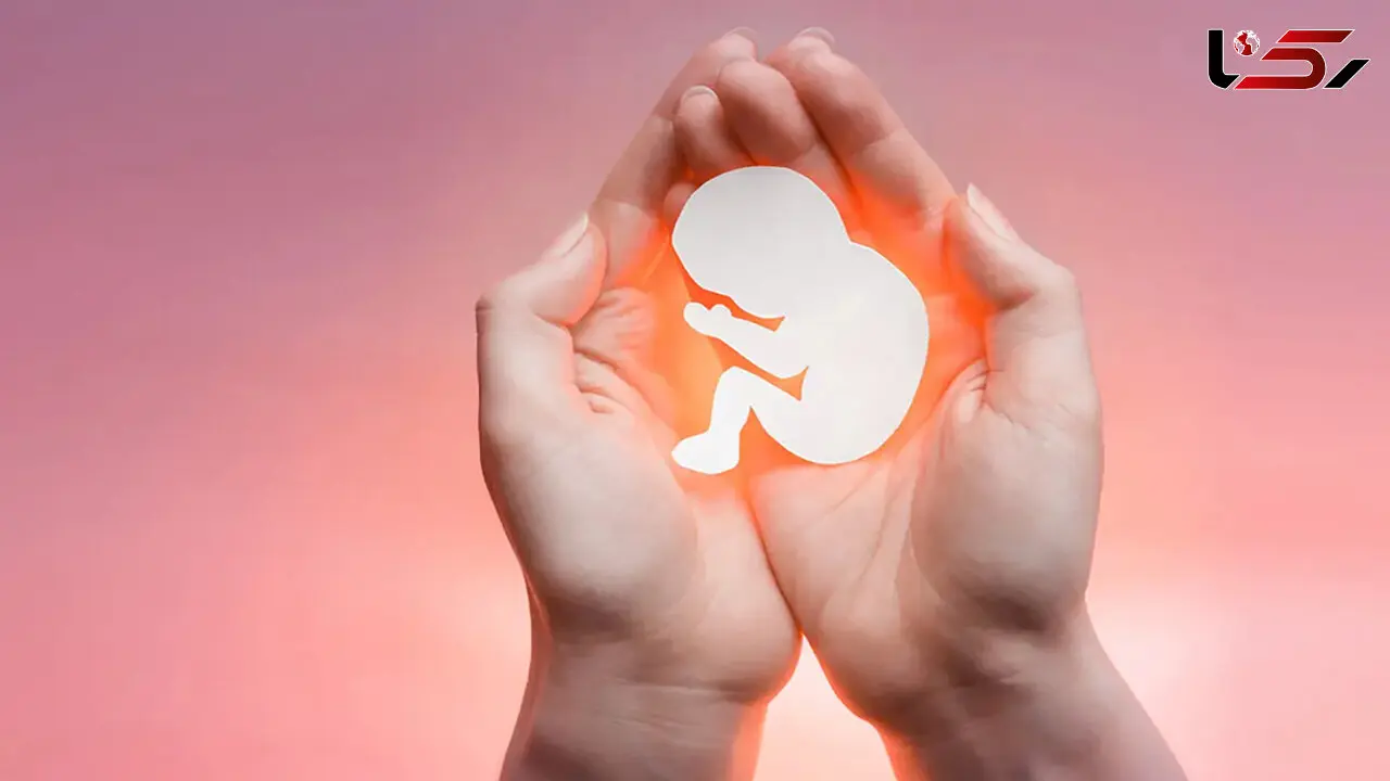 وزارت بهداشت: سقط جنین مبتلا به سندروم داون، مشروط به چه مواردی است؟