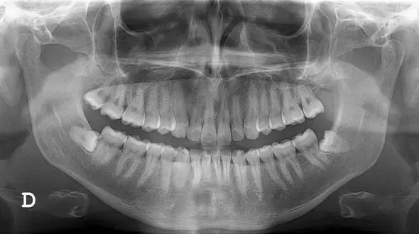 عکس opg چیست؟