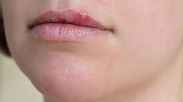 یک حبه سیر برای خلاص شدن از تبخال