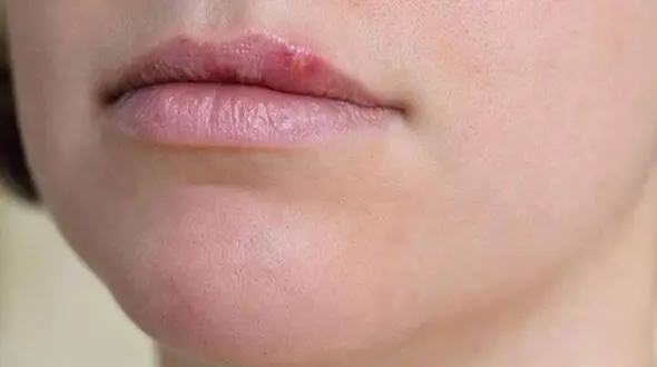 یک حبه سیر برای خلاص شدن از تبخال