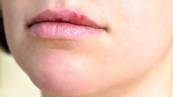 یک حبه سیر برای خلاص شدن از تبخال