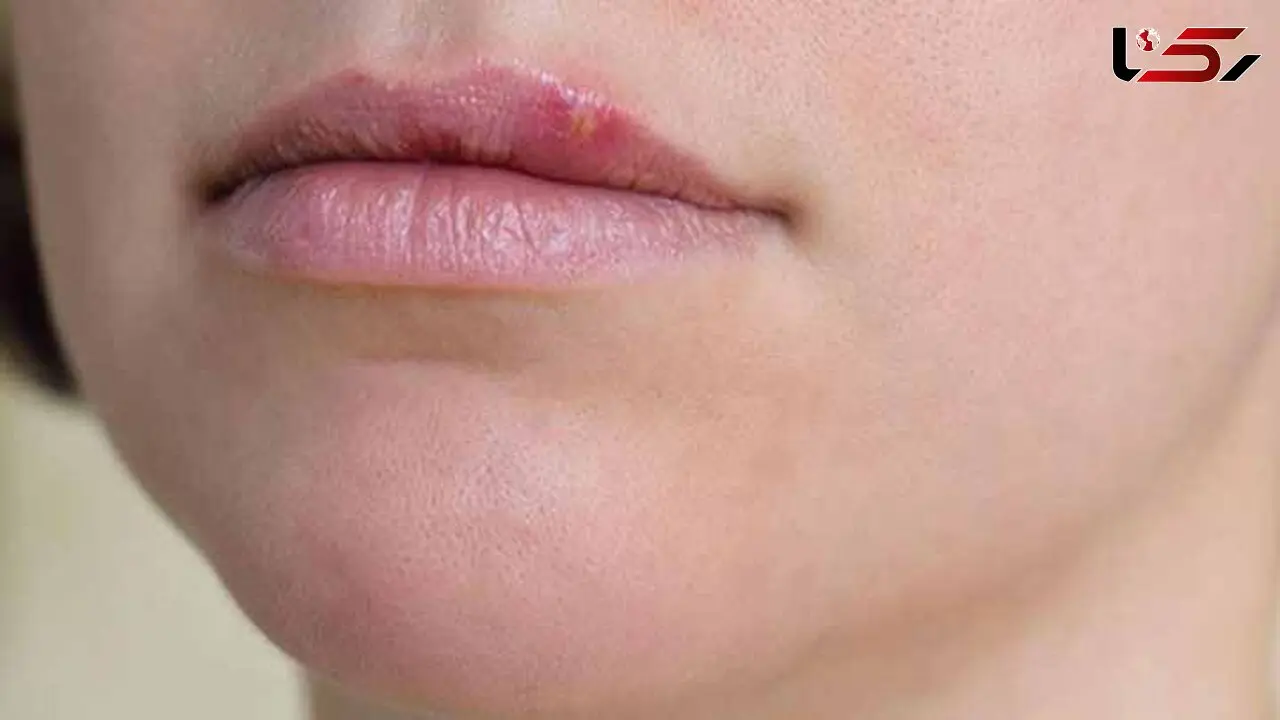 یک حبه سیر برای خلاص شدن از تبخال