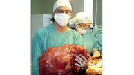 عکس سنگین ترین تومور خارج شده از بدن انسان