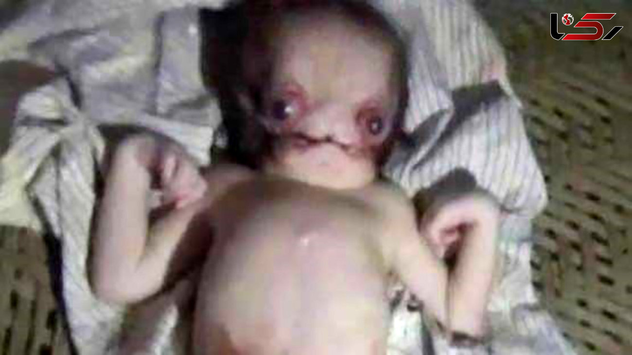 این نوزاد شبیه  موجودات فضایی است! +عکس 