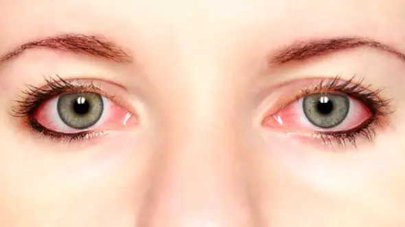 کسانی که آلرژی بهاره دارند بخوانند!