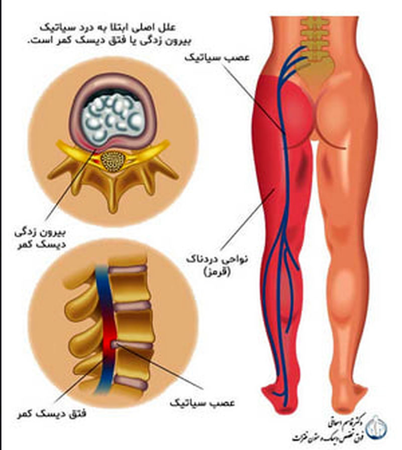 انواع دیسک کمر