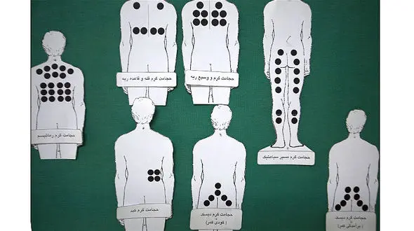 "حجامت" نخستین قدم برای درمان یا حفظ سلامتی افراد نیست 