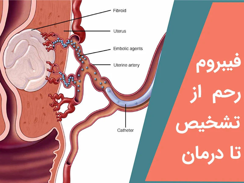 فیبروم رحم