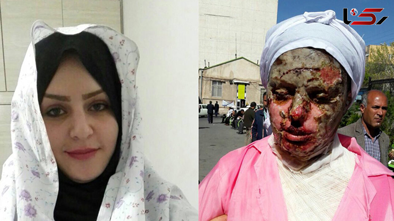 عکس تکاندهنده زن تبریزی قبل و بعد اسیدپاشی +آخرین وضعیت پرونده 