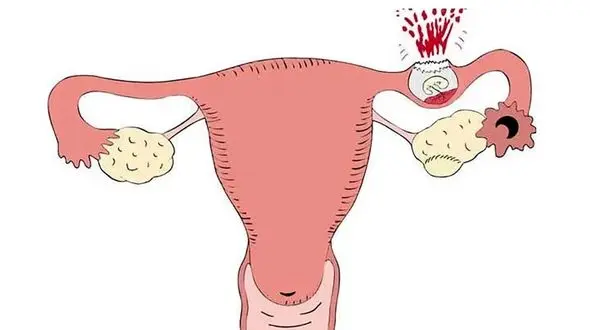 حاملگی خارج از رحم چیست؟ / 4 جدول مهم 