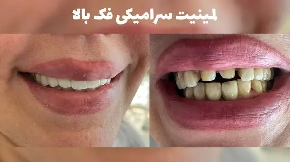 لمینت دندان در کرج کجا انجام بدم؟