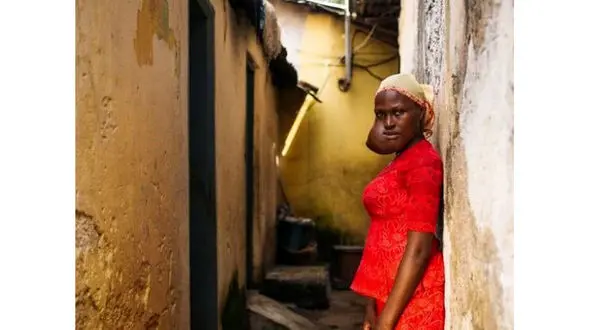 این زن جوان به خاطر تومور وحشتناک و زشت در صورتش 17سال نخندید + تصاویر