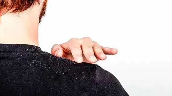 ترفندهای خانگی برای رفع شوره سر