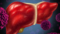 بیماران مبتلا به سیروز کبدی نیازمند تشخیص زودهنگام هستند