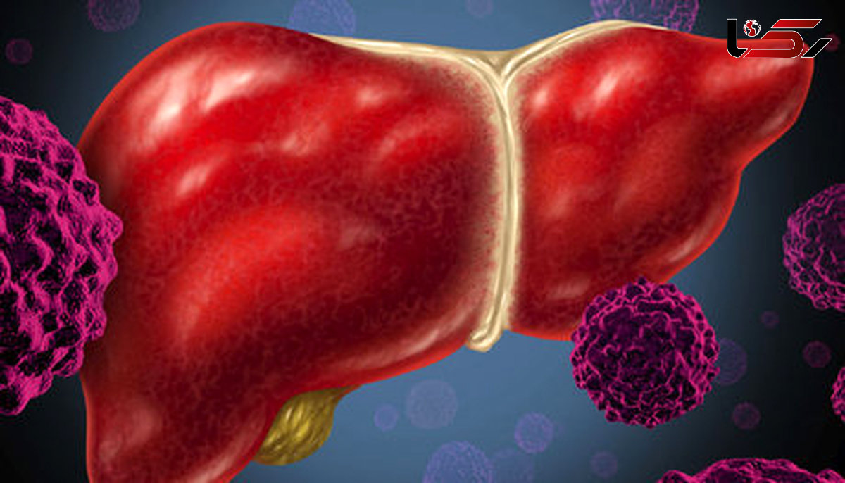 بیماران مبتلا به سیروز کبدی نیازمند تشخیص زودهنگام هستند