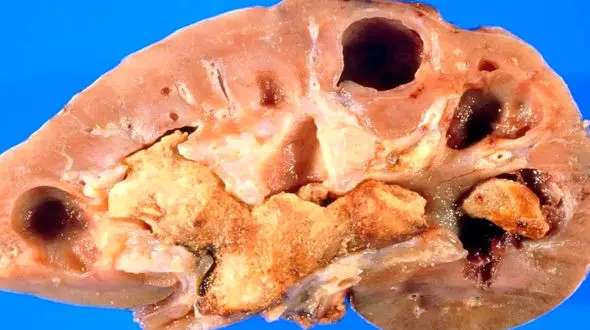 رژیم غذایی مناسب برای جلوگیری از سنگ کلیه را بشناسید + فیلم