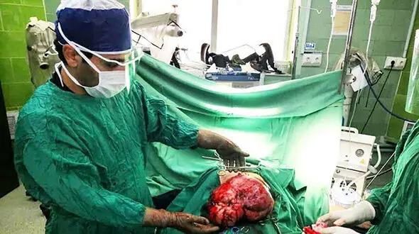 توده 6.5 کیلویی از شکم بیمار ۶٠ ساله نیشابوری خارج شد 