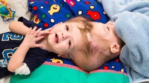 جداسازی دوقلوهای عجیب + عکس 