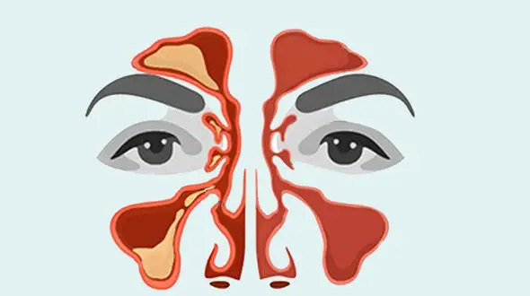 سینوزیت چه علائمی دارد؟