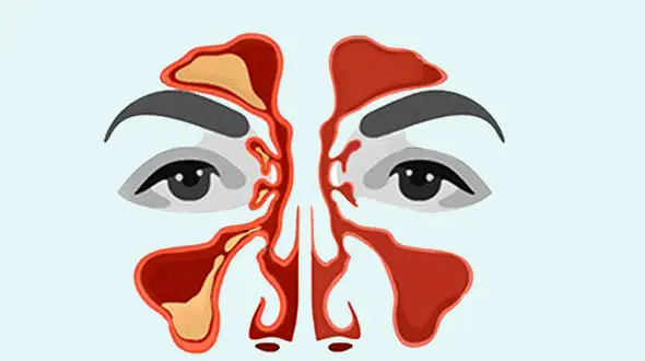 سینوزیت چه علائمی دارد؟