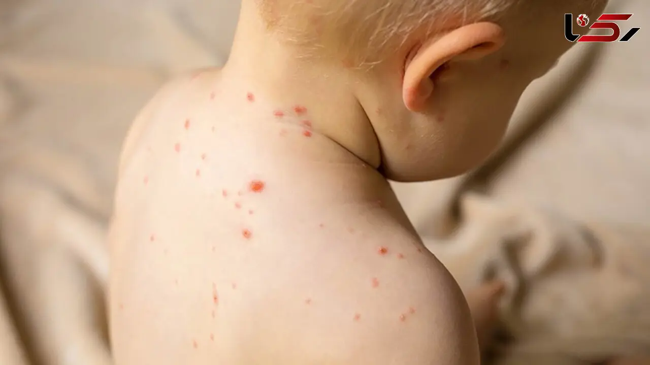 آبله میمون در تابستان اوج می گیرد