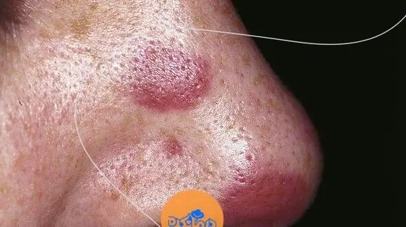 سارکوم کاپوسی یا Kaposi sarcoma چیست؟