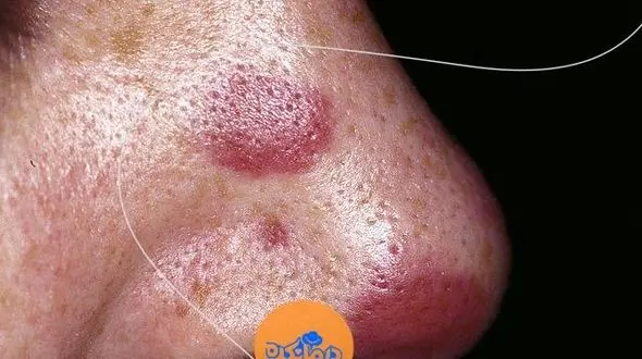 سارکوم کاپوسی یا Kaposi sarcoma چیست؟