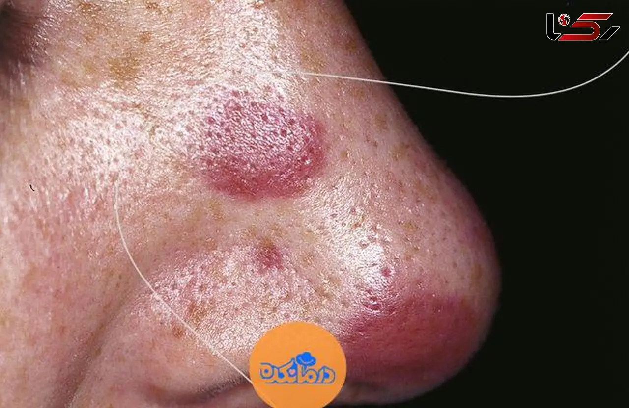 سارکوم کاپوسی یا Kaposi sarcoma چیست؟
