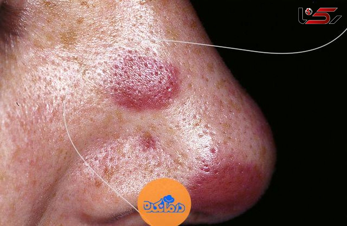 سارکوم کاپوسی یا Kaposi sarcoma چیست؟