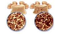 زنان مواظب خطرات وحشتناک پوکی استخوان باشند!