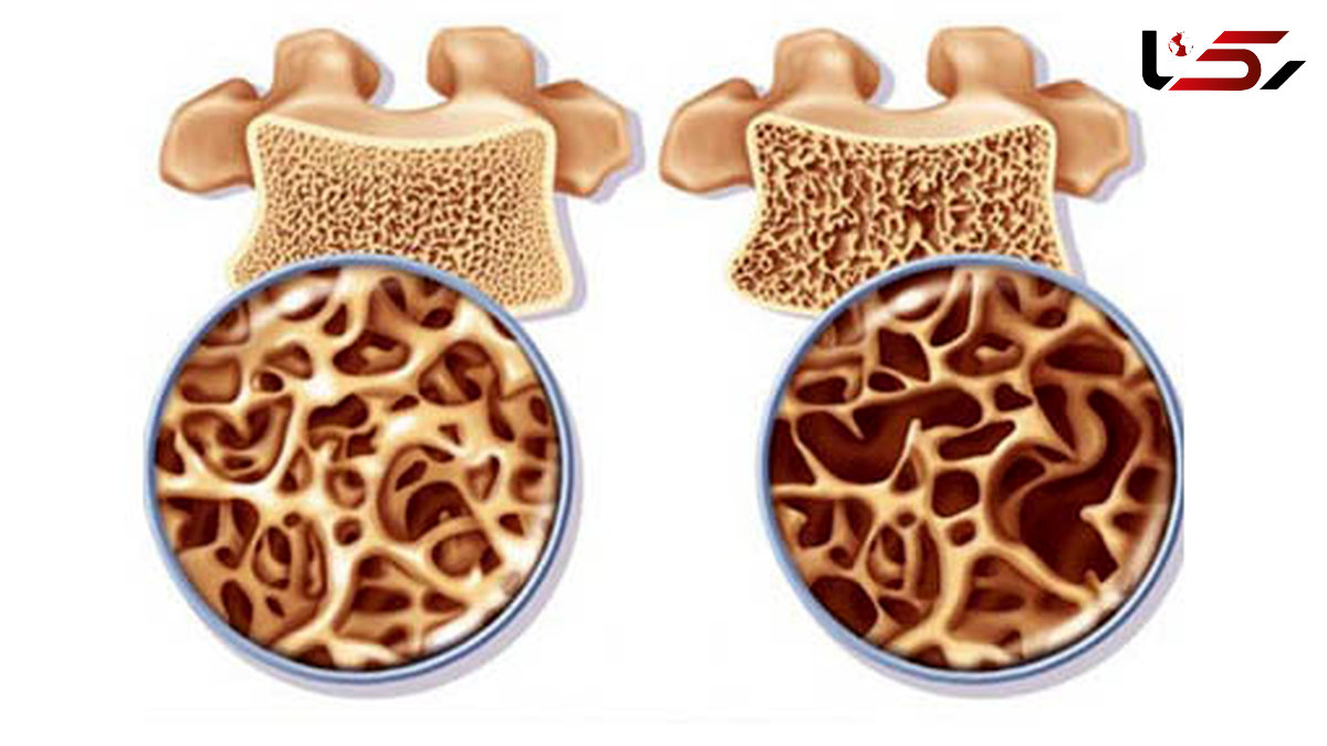 زنان مواظب خطرات وحشتناک پوکی استخوان باشند!