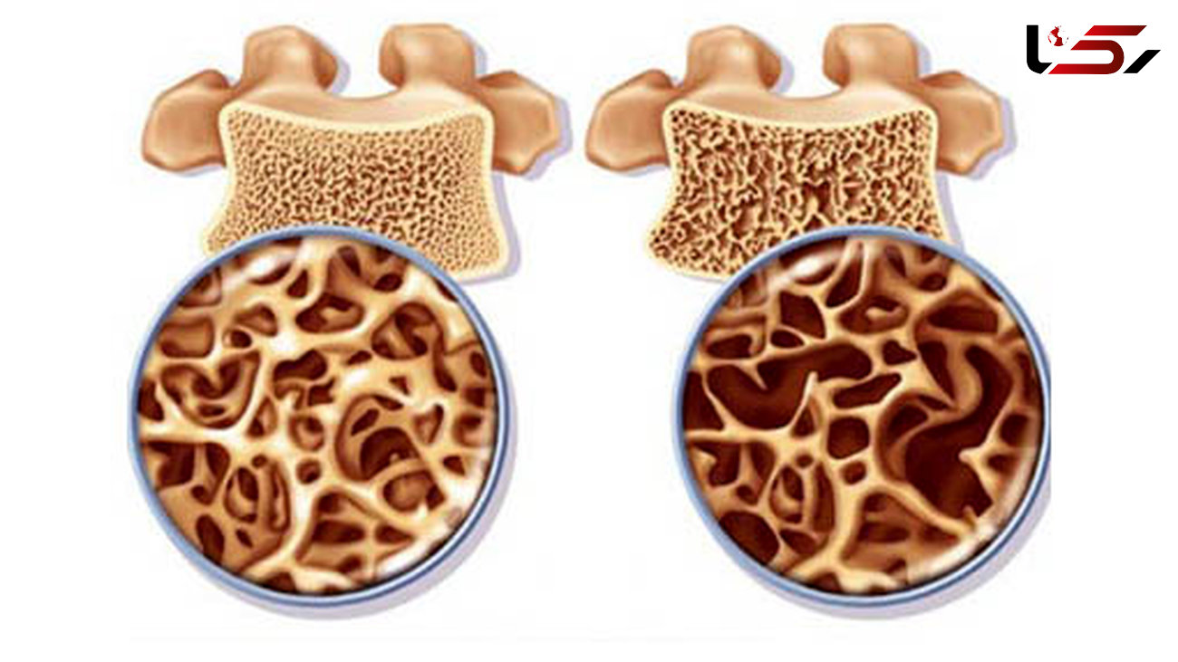 زنان مواظب خطرات وحشتناک پوکی استخوان باشند!