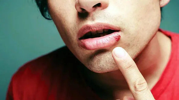 چطور از شر تبخال‌ها خلاص شویم؟