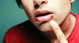 علت تبخال لب  چیست ؟ + فیلم 