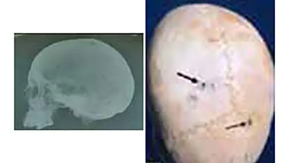 مصریان باستان هم سرطان داشتند + عکس