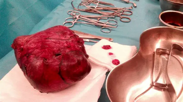 توده 5 کیلویی از بدن کودک 1 ساله اهوازی خارج شد+ تصاویر 