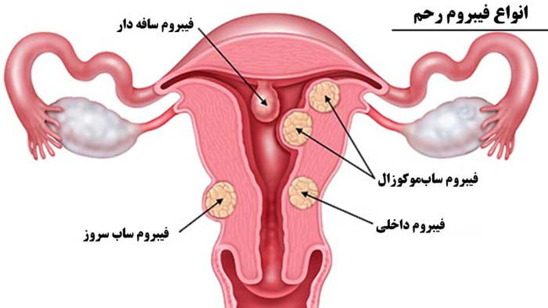 فیبروم رحم