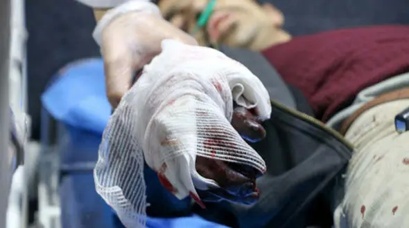 انگشتان دست پسربچه جوانرودی قطع شد / چهارشنبه سوری تلخ برای پسر 14 ساله