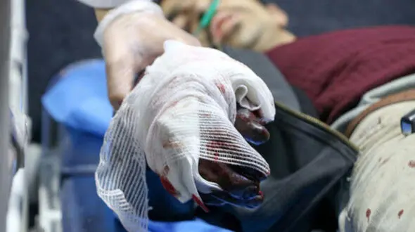 انگشتان دست پسربچه جوانرودی قطع شد / چهارشنبه سوری تلخ برای پسر 14 ساله