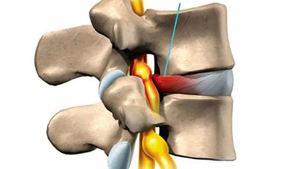 نحوه درمان دیسک کمر