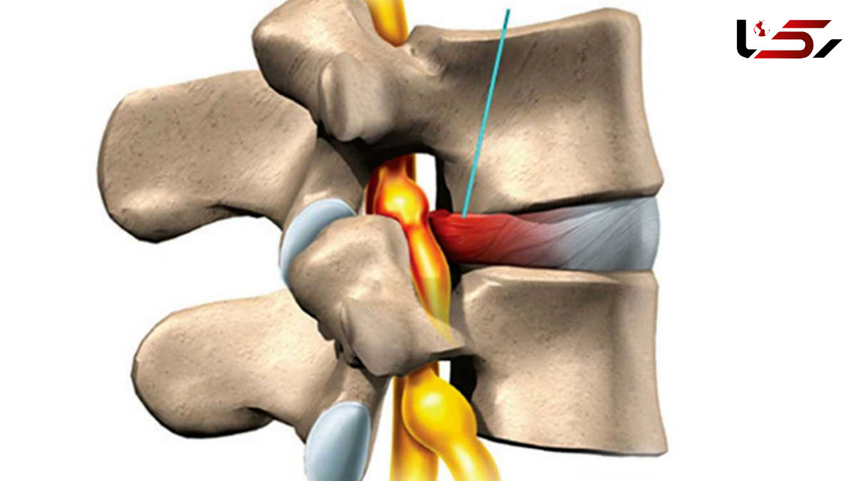 نحوه درمان دیسک کمر