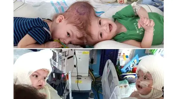 لحظه دیدنی ملاقات دوقلوهای بهم چسبیده از سر بعد از جدایی+عکس