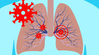 ارتباط نارسایی تنفسی کرونا با گروه‌ خونی